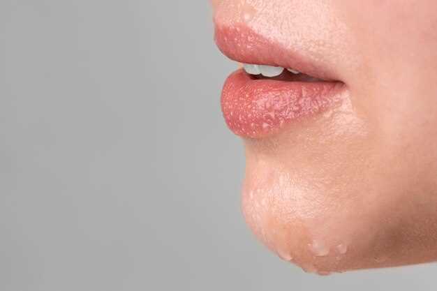 Натуральные способы борьбы с герпесом на губах